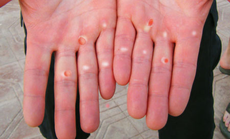 Gordons blisters  after day 1